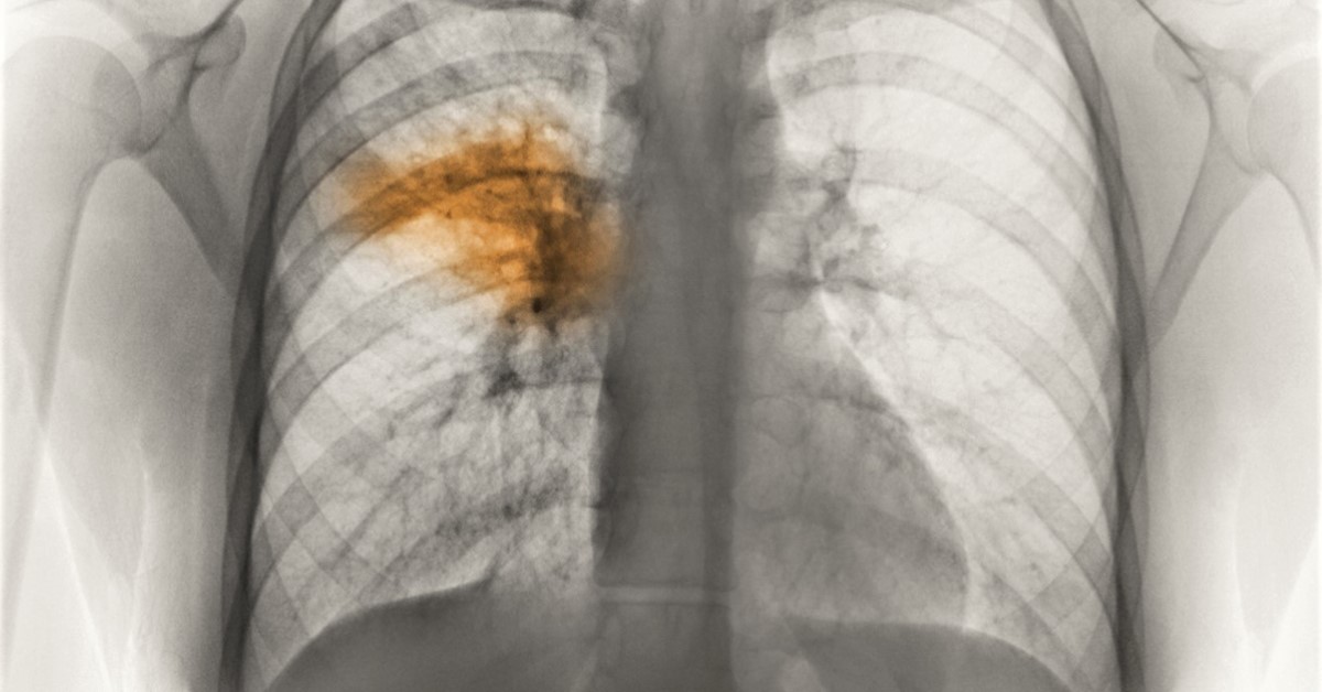 Tüdőgyulladás: veszélyes összefüggésekre figyelmeztetnek a tudósok