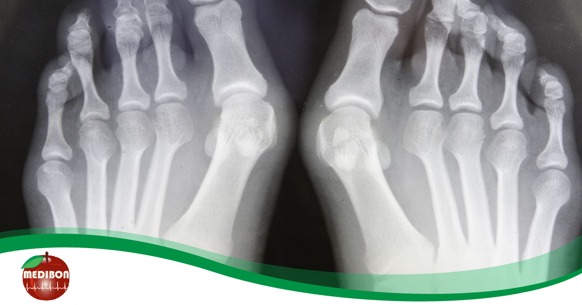 Miért fontos megelőzni a láb bütykeinek kialakulását?