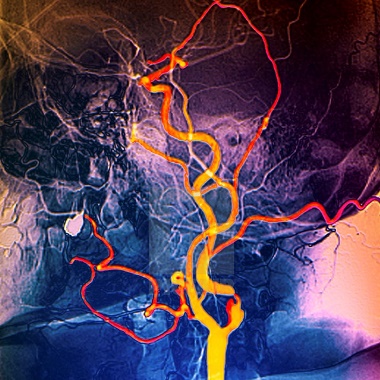 Nyaki erek color Doppler ultrahang vizsgálata radiológus szakorvossal a Benyovszky Orvosi Központban