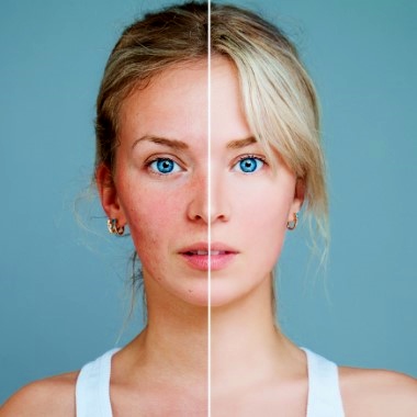 Aknék, hegek, pigmentfoltok tarkítják az arcod, rád férne egy kortalanító kezelés? Mellékhatásoktól mentes, egyedülállóan hatékony MesoPen teljes arckezelés. 